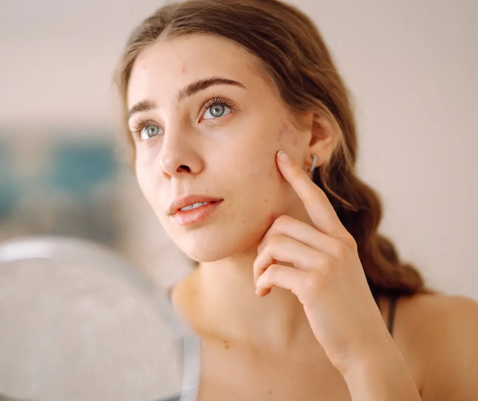acne treatment in ghaziabad