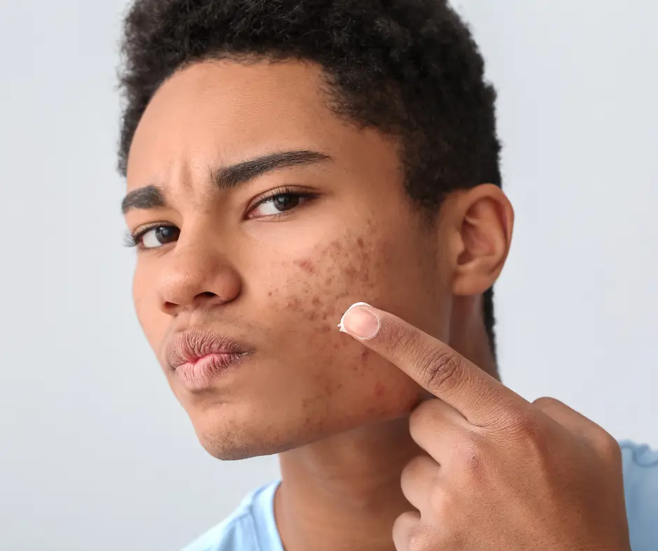 best clinic for acne treatment near me