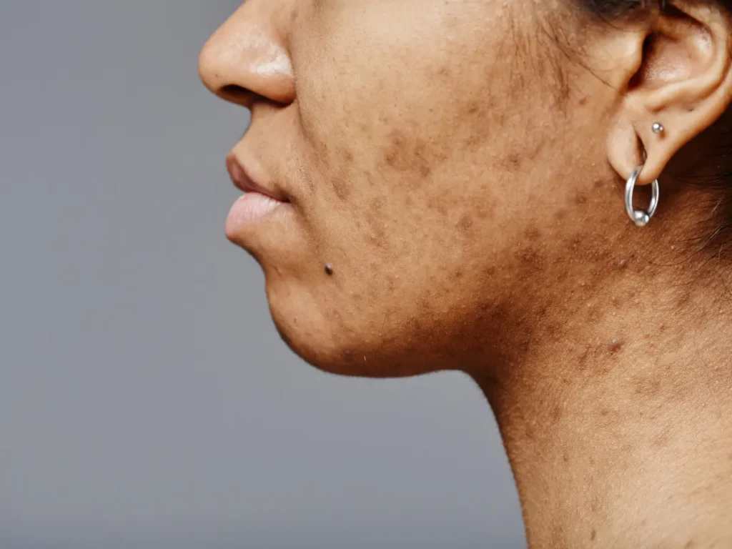 best treatment for acne