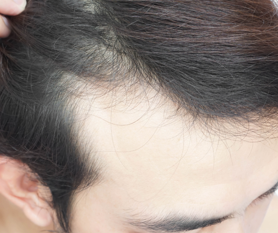 Top 5 hair fall treatments in Ghaziabad