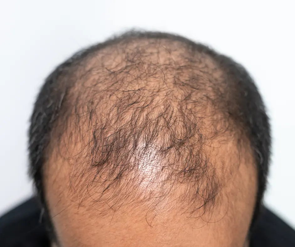 Hair fall treatment clinic Indirapuram