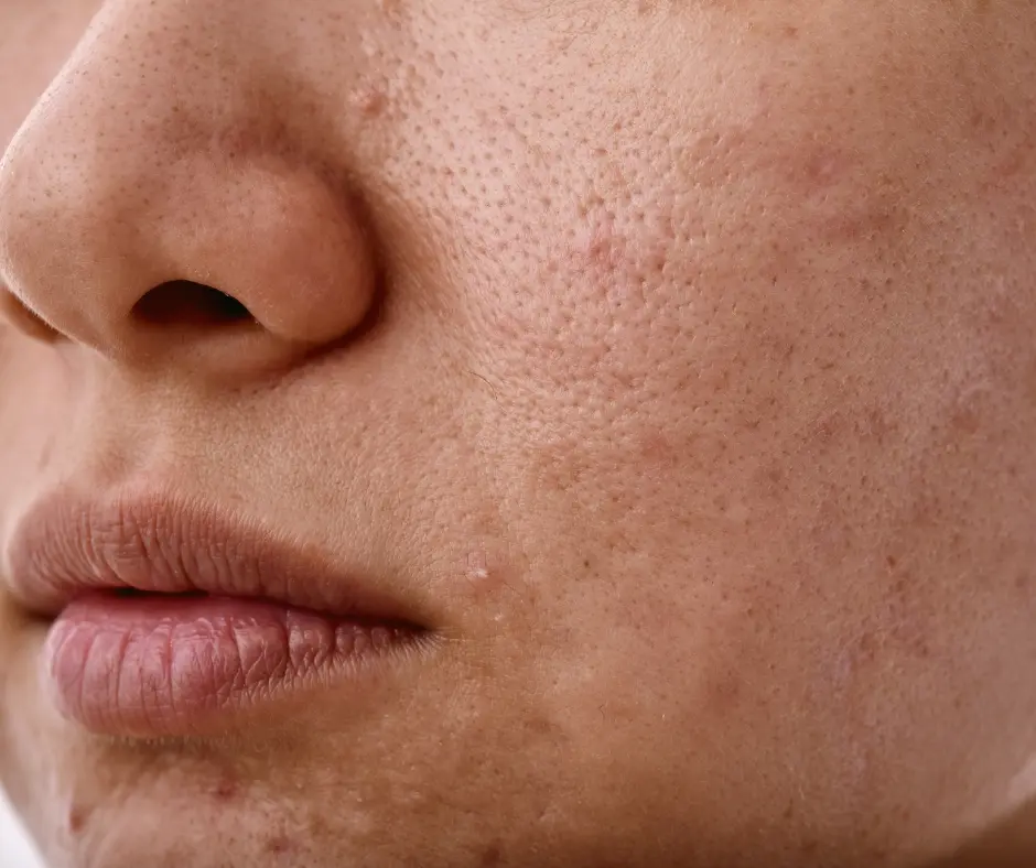 how to remove dead skin from face