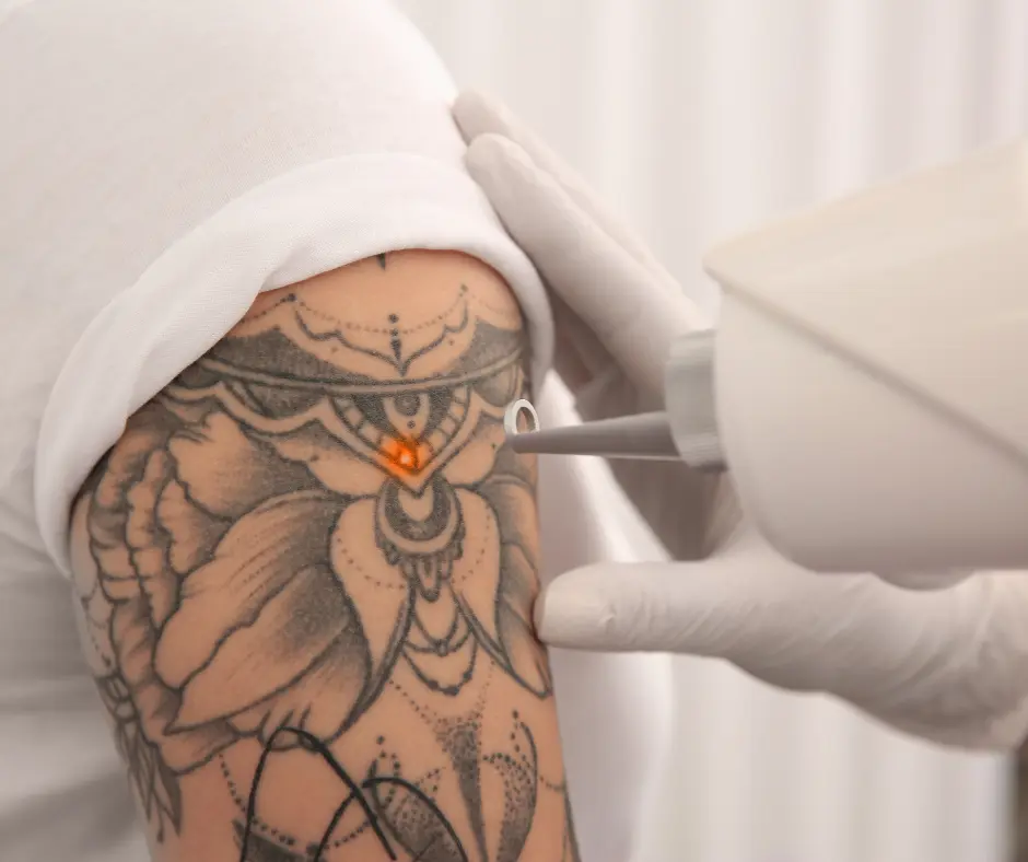 Tattoo removal clinic near me