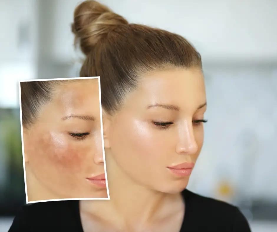 Dark Spots Treatment in Raj Nagar Extension