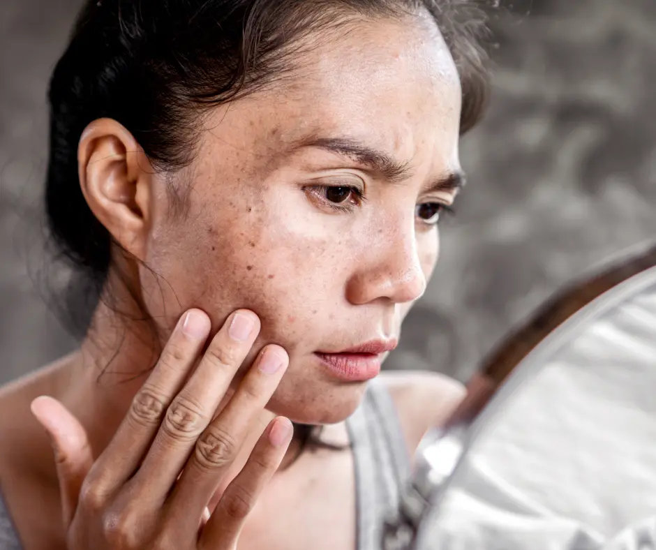 Facial Pigmentation Treatment in Raj Nagar Extension