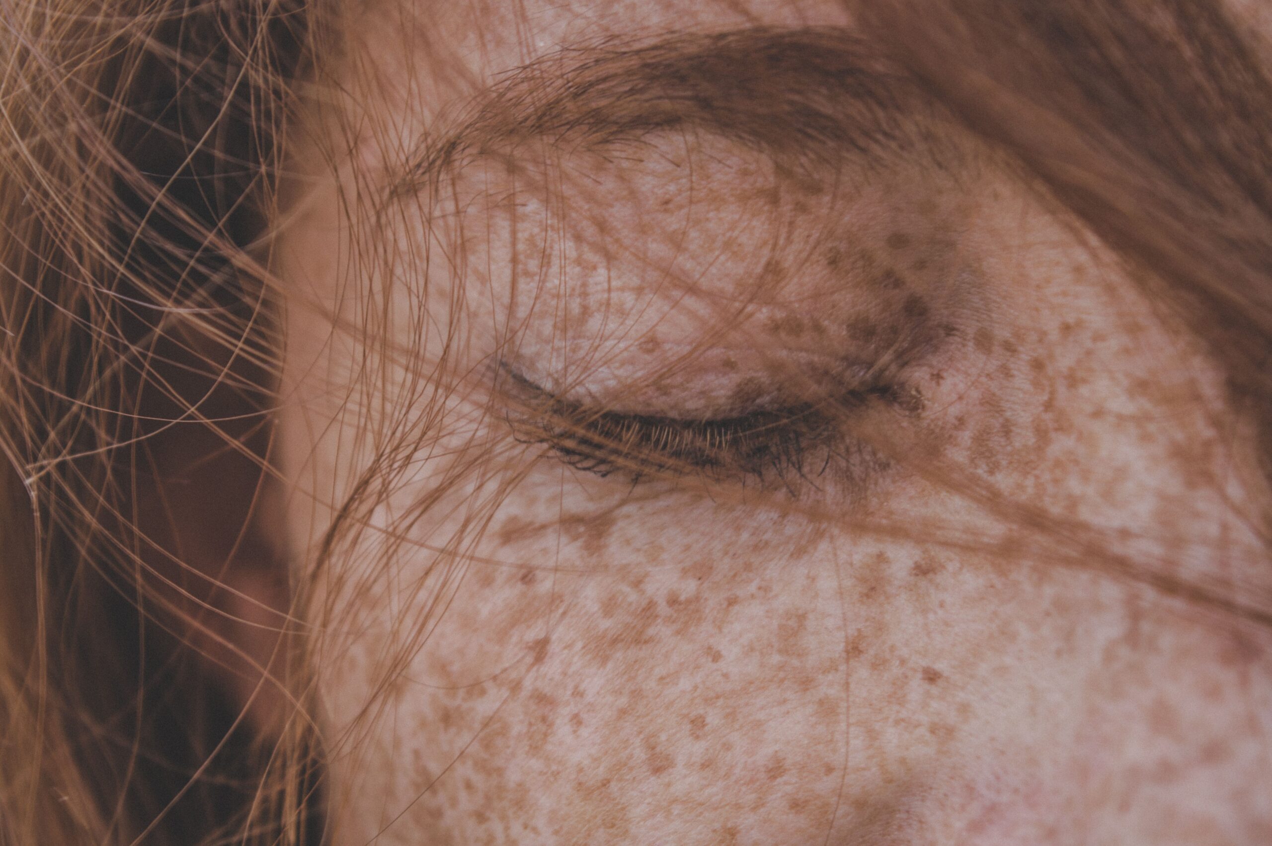 Hyperpigmentation Treatment in Raj Nagar Extension